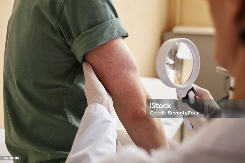 Close up of doctor inspecting skin with magnifying glass while examining patient in dermatology clinic